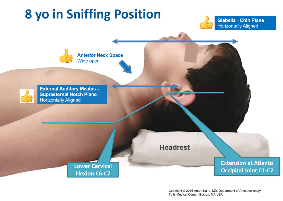 Supine patient positioning and portal designation. (A) Supine position